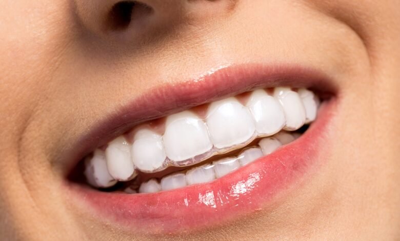 How Long Does Invisalign Take